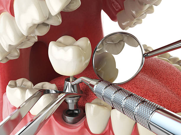 Best Emergency Dental Extractions in Lockport Heights, IL
